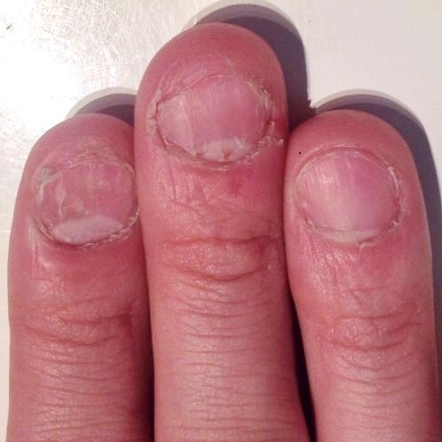 爪を噛む癖や 爪むしる癖 爪をいじる癖を治す方法はありますか 育爪サロン ラメリック