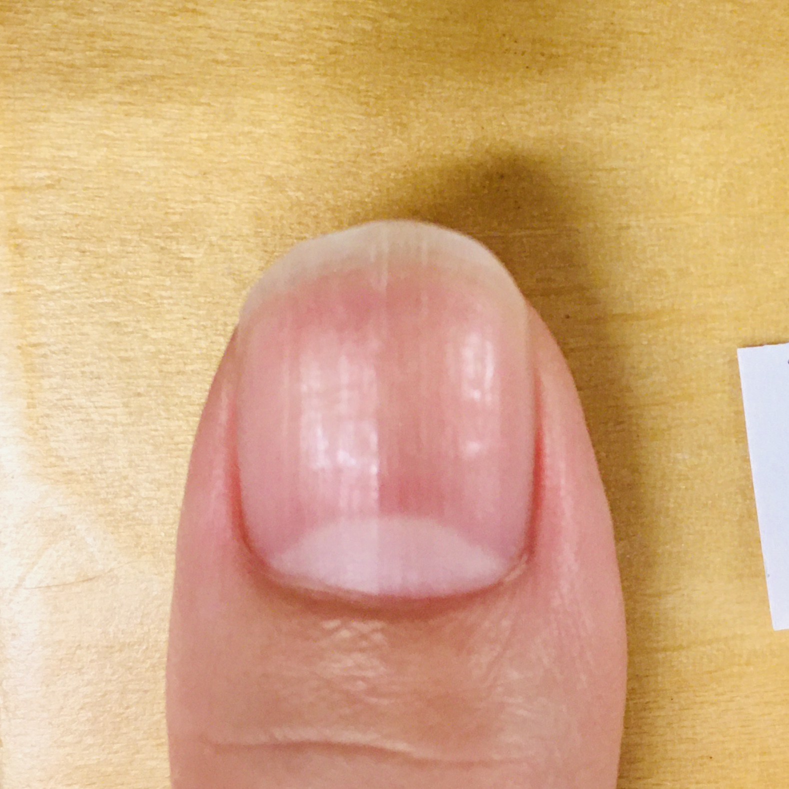 アークスクエア 育爪カット でキレイな形の立体的な爪になりました 育爪サロン ラメリック